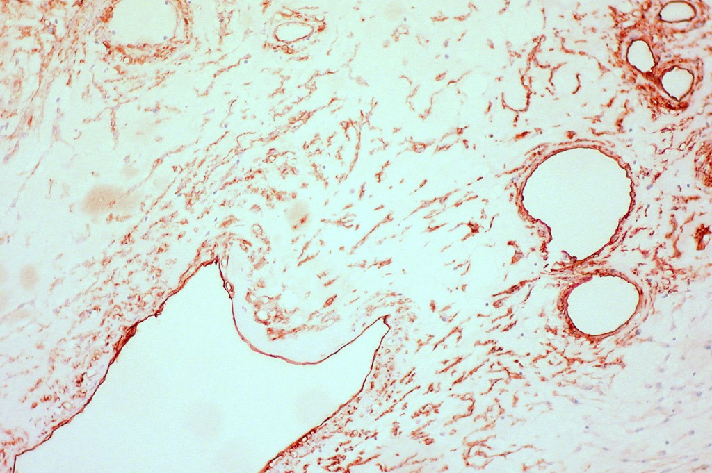 ピンクリボンで考える、デザインの病理